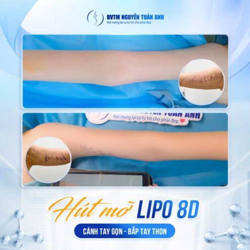 Giải Pháp Cho Bắp Tay Thon Gọn Không Cần Tập Luyện